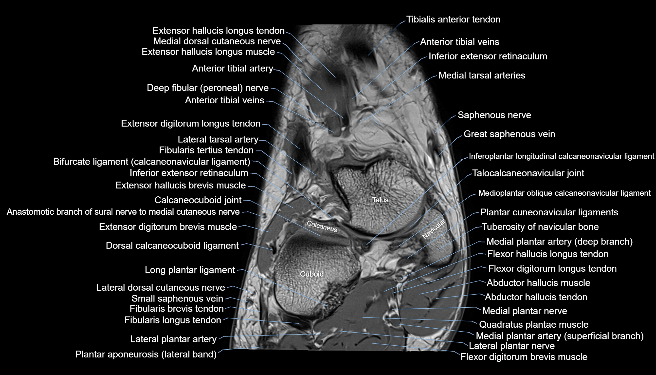 Ankle coronal anatomy 3T MRI images -img-11001-00003.webp